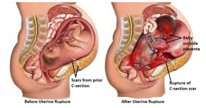 Vỡ tử cung một tai biến sản khoa nguy hiểm - Ảnh minh họa