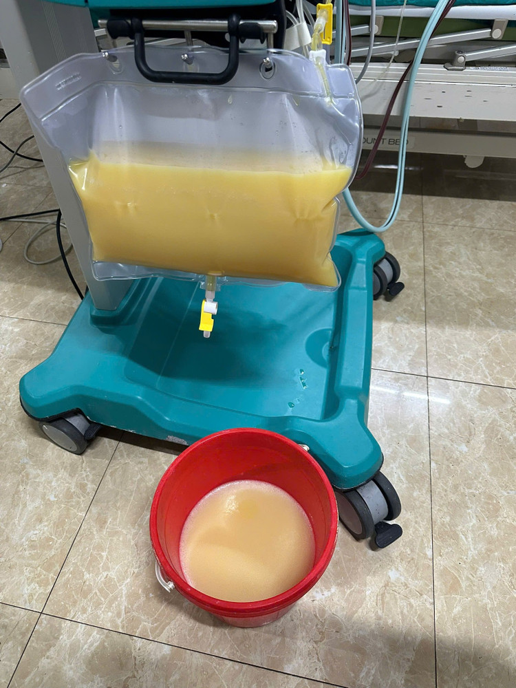 Máu của bệnh nhân nhiễm mỡ trắng như sữa - Ảnh BVCC