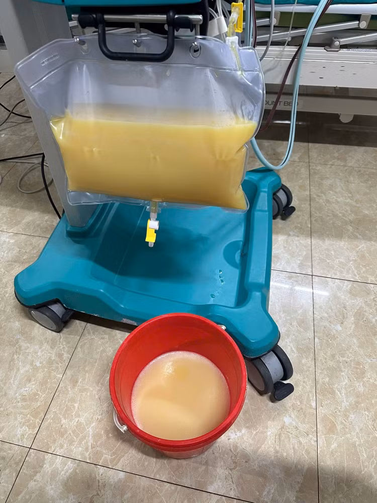 Máu của bệnh nhân nhiễm mỡ trắng như sữa - Ảnh BVCC