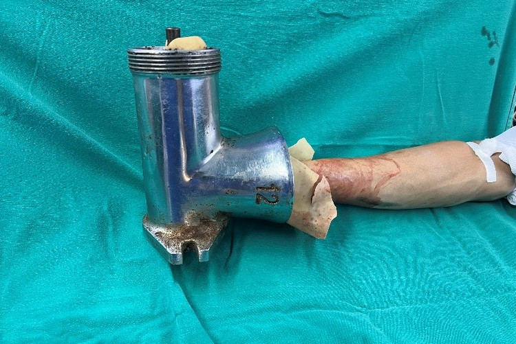 Bàn tay phải dập nát và dính vào máy xay thịt - Ảnh BVCC