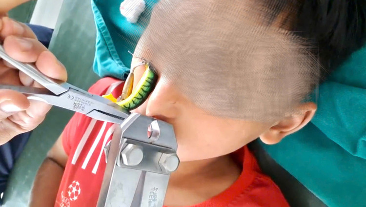 Thủ thuật lấy lưỡi câu ra khỏi mũi bệnh nhi - Ảnh BVCC