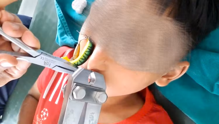 Thủ thuật lấy lưỡi câu ra khỏi mũi bệnh nhi - Ảnh BVCC