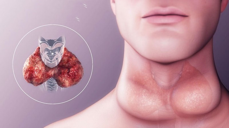 HDL thấp làm tăng nguy cơ tái phát ung thư tuyến giáp thể nhú - Ảnh BSCC