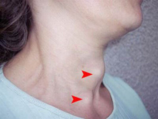 HDL thấp làm tăng nguy cơ tái phát ung thư tuyến giáp thể nhú - Ảnh BVCC