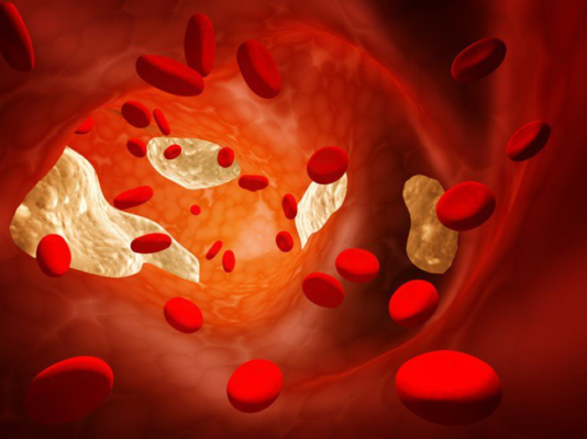 Cholesterol HDL thấp trước khi phẫu thuật có nguy cơ cao hơn tái phát ung thư tuyến giáp - Ảnh minh hoạ