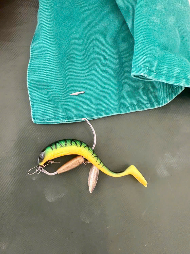 Lưới câu đã được lấy ra khỏi mũi bệnh nhi - Ảnh BVCC