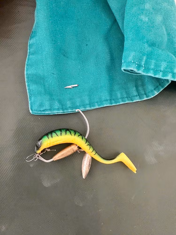 Lưới câu đã được lấy ra khỏi mũi bệnh nhi - Ảnh BVCC