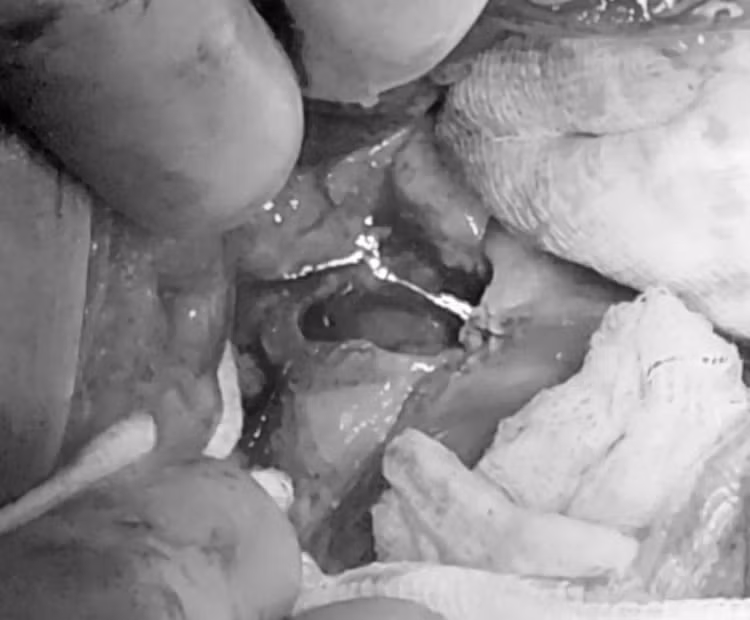  Sốc nhiễm trùng, nhiễm độc nặng do thủng tạng rỗng mà không biết ảnh 4