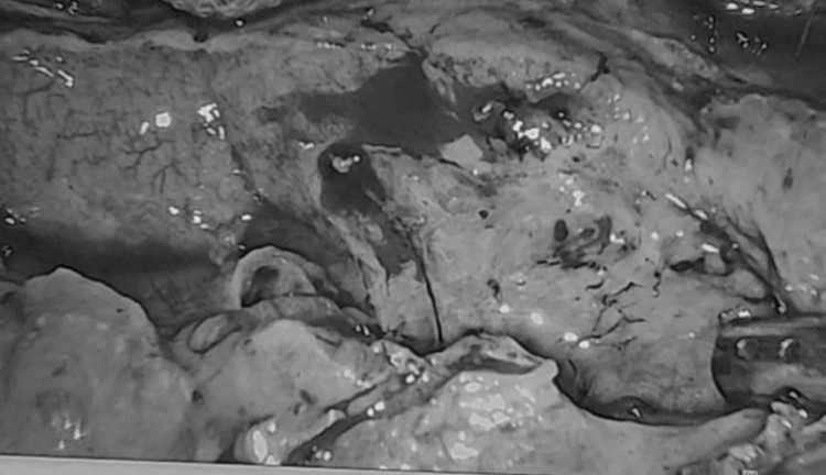  Sốc nhiễm trùng, nhiễm độc nặng do thủng tạng rỗng mà không biết ảnh 3