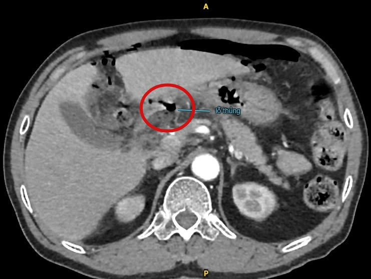  Sốc nhiễm trùng, nhiễm độc nặng do thủng tạng rỗng mà không biết ảnh 1