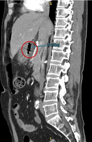  Sốc nhiễm trùng, nhiễm độc nặng do thủng tạng rỗng mà không biết ảnh 2