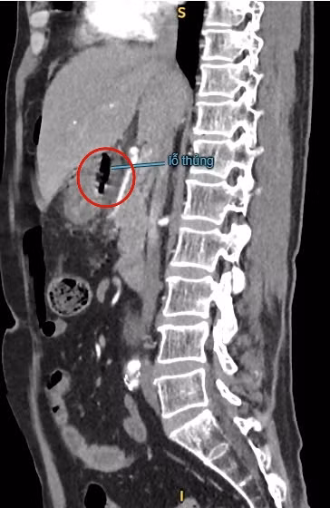  Sốc nhiễm trùng, nhiễm độc nặng do thủng tạng rỗng mà không biết ảnh 2