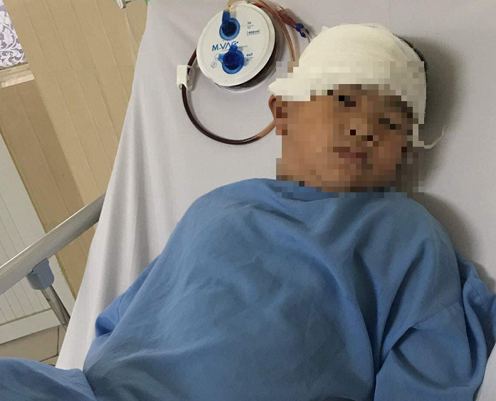 Cậu bé bị bệnh Moyamoya khi điều trị tại bệnh viện Việt Đức