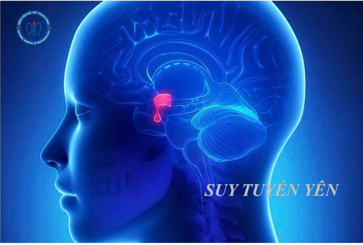 Sau sinh cẩn thận mắc bệnh suy tuyến yên nguy hiểm: cần nhận biết sớm Sau sinh cẩn thận mắc bệnh suy tuyến yên nguy hiểm: cần nhận biết sớm