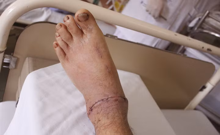 Nối thành công bàn chân bị máy cắt cỏ chém gần đứt rời cổ chân ảnh 1