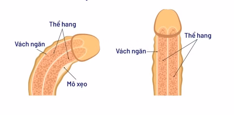 Bác sĩ mách cách điều trị cong dương vật ảnh 1