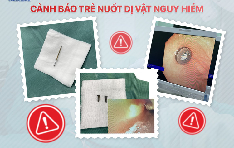 Hai chiếc đinh vít sắc nhọn, nguy hiểm trong bụng trẻ ảnh 1