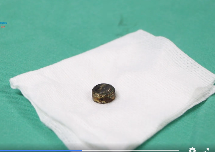 Dị vật pin Cúc áo được lấy ra Dị vật pin Cúc áo được lấy ra