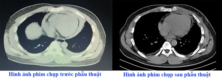 Hình ảnh tràn dịch màng tim gây ép tim trên phim chụp tại Trung tâm Y tế huyện Cẩm khê