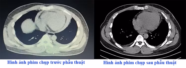 Hình ảnh tràn dịch màng tim gây ép tim trên phim chụp tại Trung tâm Y tế huyện Cẩm khê