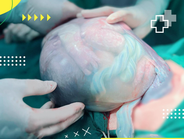 Trẻ được sinh ra trong &quot;bọc điều&quot; - Ảnh BVCC