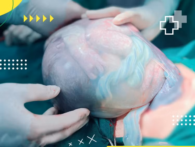 Trẻ được sinh ra trong "bọc điều" - Ảnh BVCC