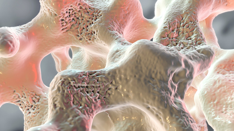 Loãng xương - Ảnh minh họa