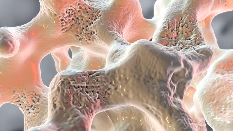 Loãng xương - Ảnh minh họa