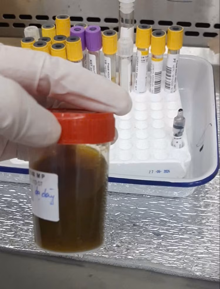 Cụ ông nguy kịch vì giun lươn lan tỏa kèm bệnh lý nền ảnh 2