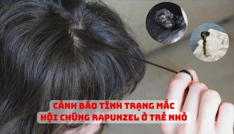 Nhiều trẻ ăn tóc bị tắc ruột và hội chứng Rapunzel liên quan thần kinh - Ảnh BVCC