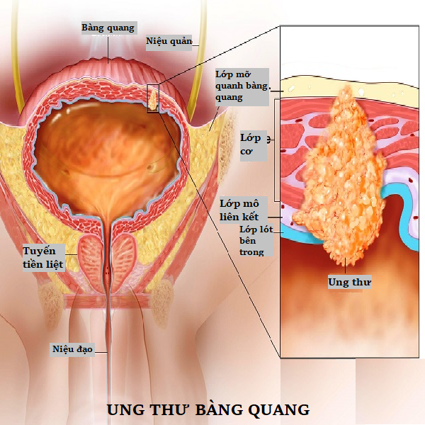 Dấu hiệu ung thư bàng quang - Ảnh minh họa