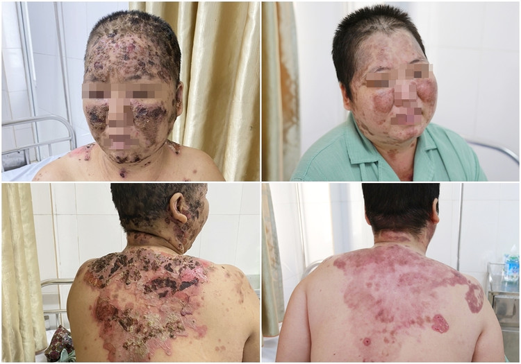 Vùng da tổn thương bị bội nhiễm của bệnh nhân M. được bác sĩ điều trị ổn định.