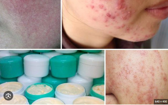 Điều trị da bôi kem trộn corticoid khó như cai nghiện ma túy - Ảnh minh họa