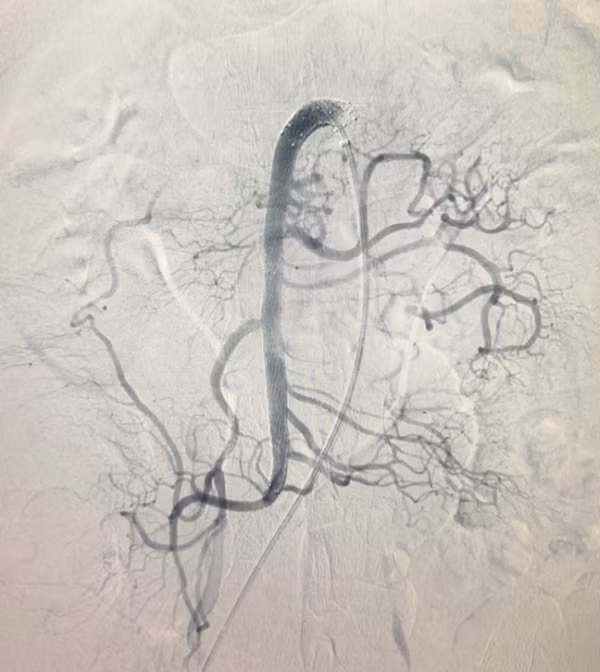 Cứu sống người đàn ông mắc bệnh rất hiếm gặp ảnh 4