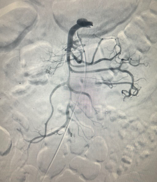 Cứu sống người đàn ông mắc bệnh rất hiếm gặp ảnh 3