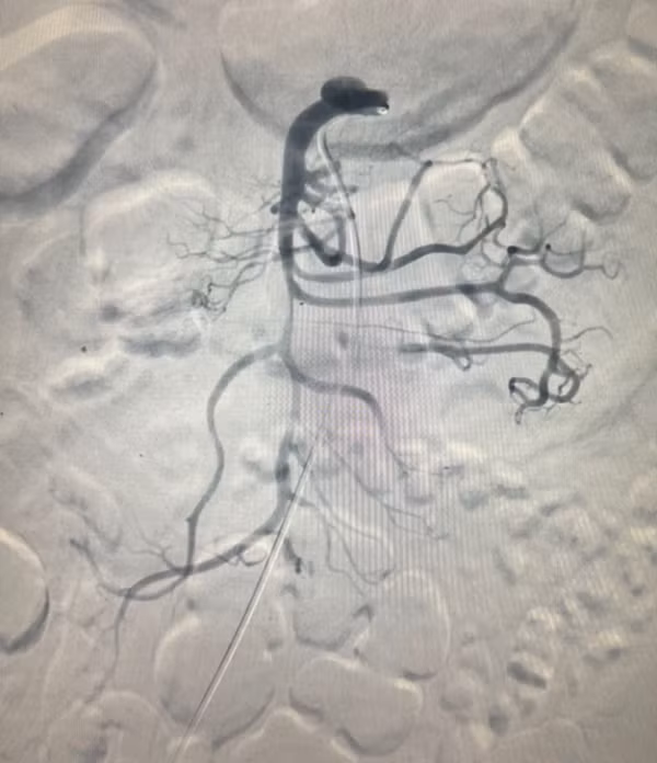 Cứu sống người đàn ông mắc bệnh rất hiếm gặp ảnh 3