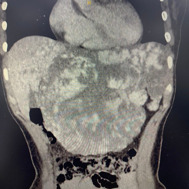 Khối u máu gan khổng lồ trên phim chụp