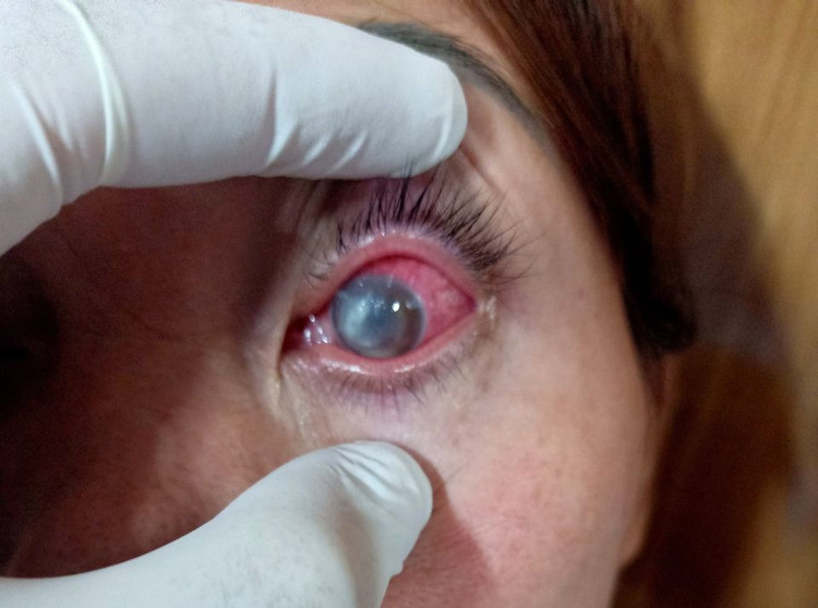 Bệnh nhân nữ tự mua thuốc điều trị đau mắt đỏ, dẫn đến loét giác mạc, mủ tiền phòng