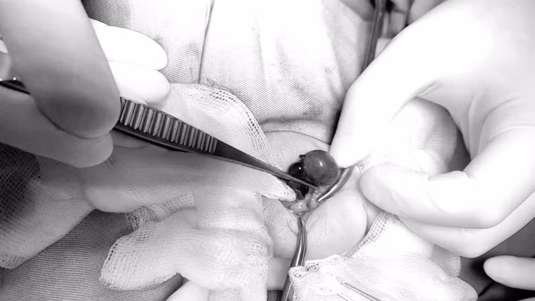 Tinh hoàn của bệnh nhi đã hoại tử, tím đen