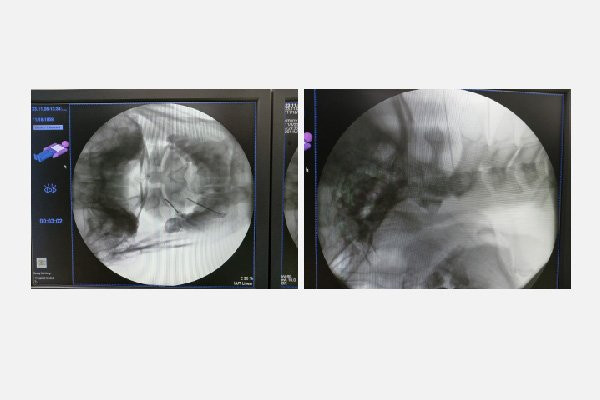 Hình ảnh khi đưa kim đốt sóng cao tần vào đúng vị trí giải phẫu