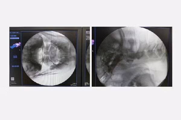 Hình ảnh khi đưa kim đốt sóng cao tần vào đúng vị trí giải phẫu