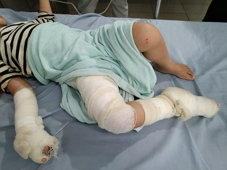 Bệnh nhân bị bỏng nước sôi