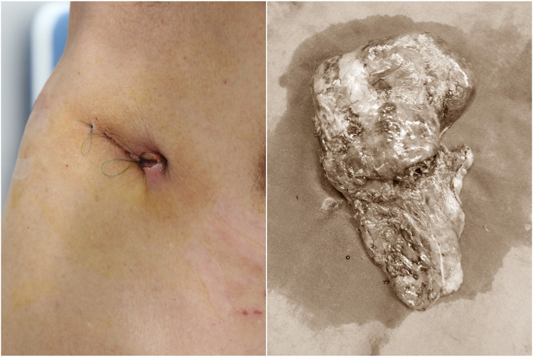 Khối u được lấy ra nhẹ nhàng bằng phương pháp nội soi cắt thuỳ phổi một đường rạch.