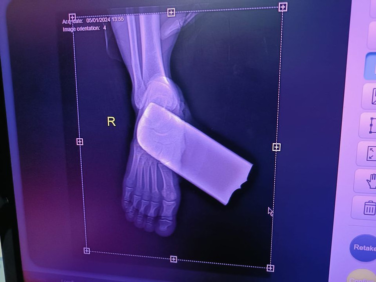 Bệnh nhân bị lưỡi máy cắt cỏ gãy bắn găm vào bàn chân phải gây tổn thương đứt cơ gan bàn chân và mạch máu