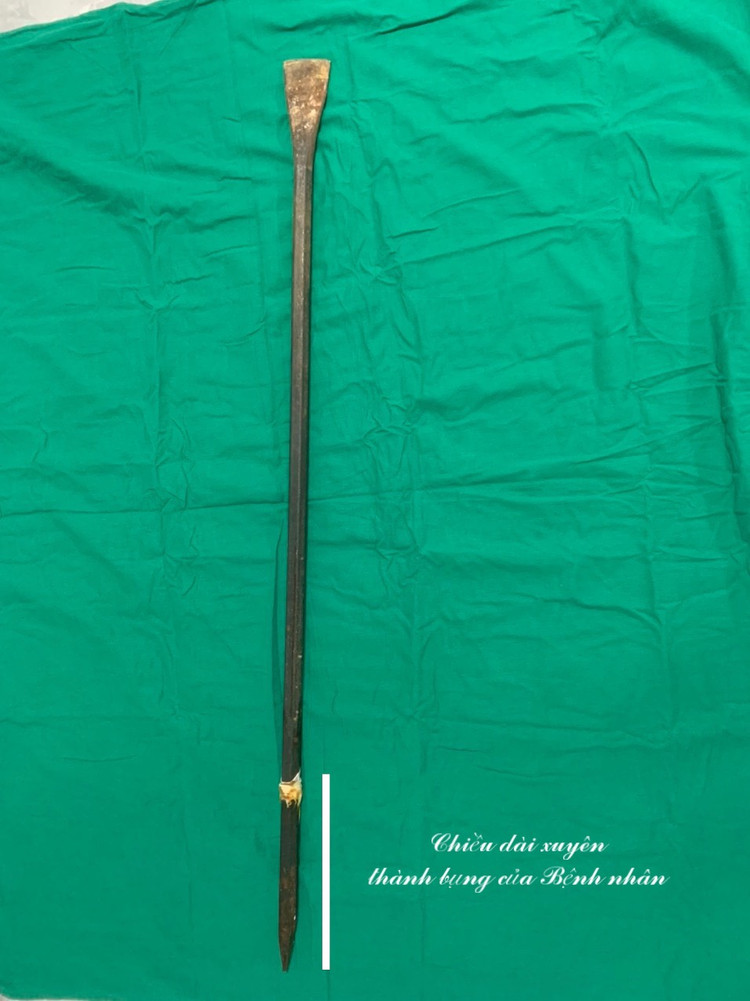 Thanh xà beng được rút ra khỏi người bệnh nhân an toàn