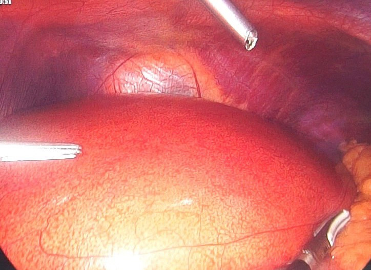 Mỡ nội tạng phủ trắng gan