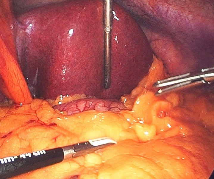 Mỡ tích tụ trong mạc nối lớn của bệnh nhân nữ 30 tuổi