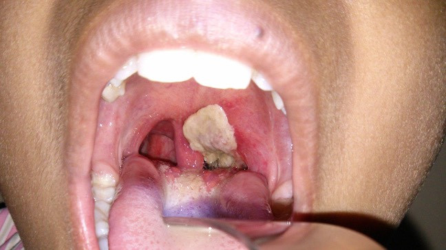 Hình ảnh giả mạc trong bệnh bạch hầu - Ảnh BVCC