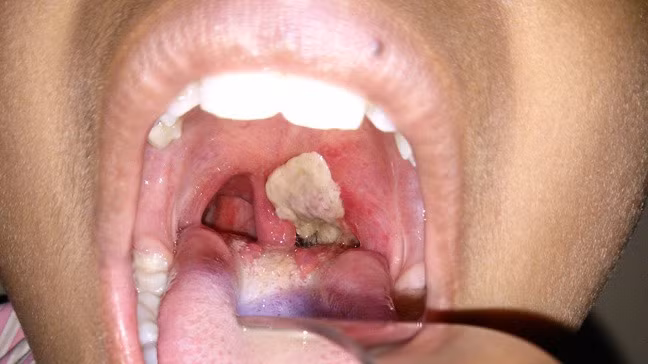 Hình ảnh giả mạc trong bệnh bạch hầu - Ảnh BVCC