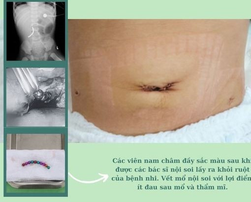 2,5 giờ nội soi lấy 10 cục nam châm khiến bé trai 18 tuổi thủng ruột ảnh 1